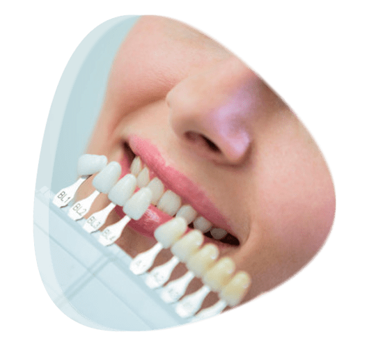 Asesoramiento sobre prótesis bucal en Tlalnepantla de Baz